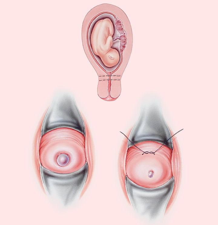 Incompetent cervix stitch Treatment GetWellGo India s Best